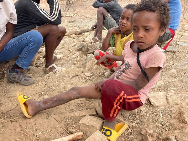 Äthiopien verletztes Kind